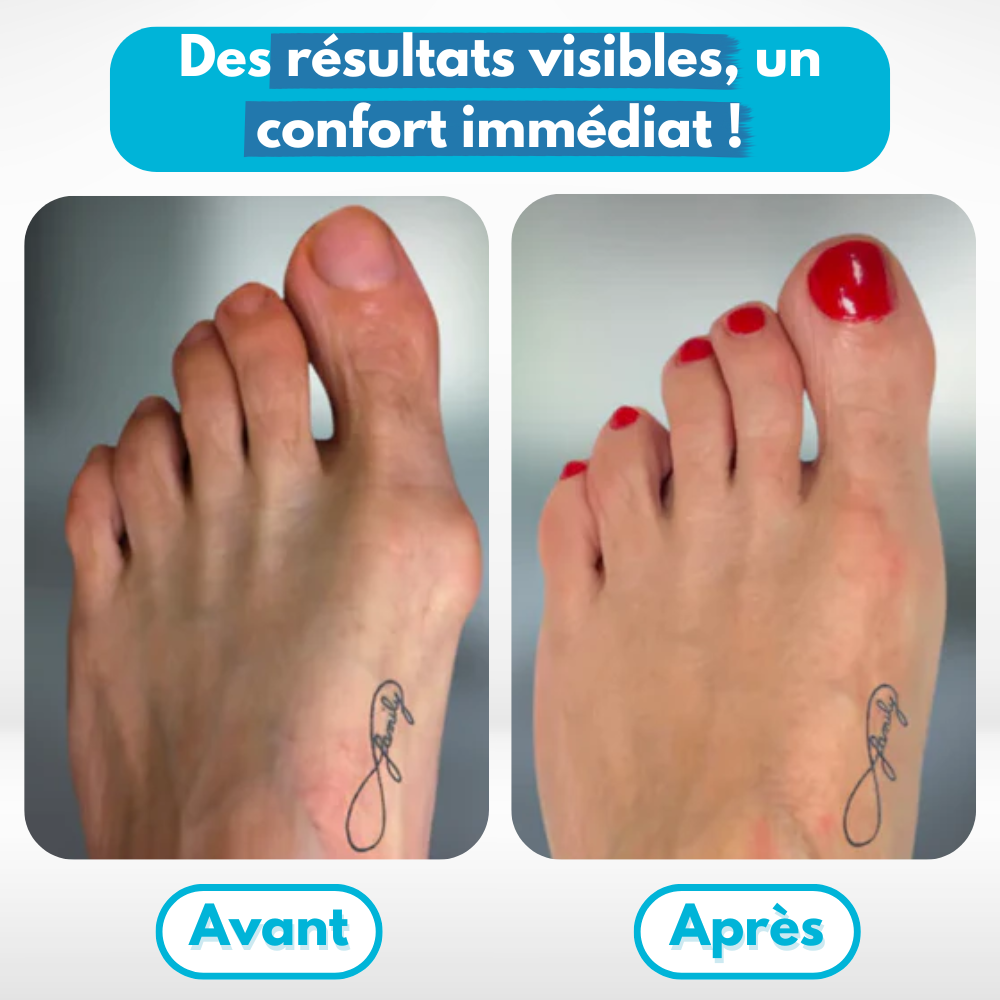 Correcteur universel pour Hallux Valgus